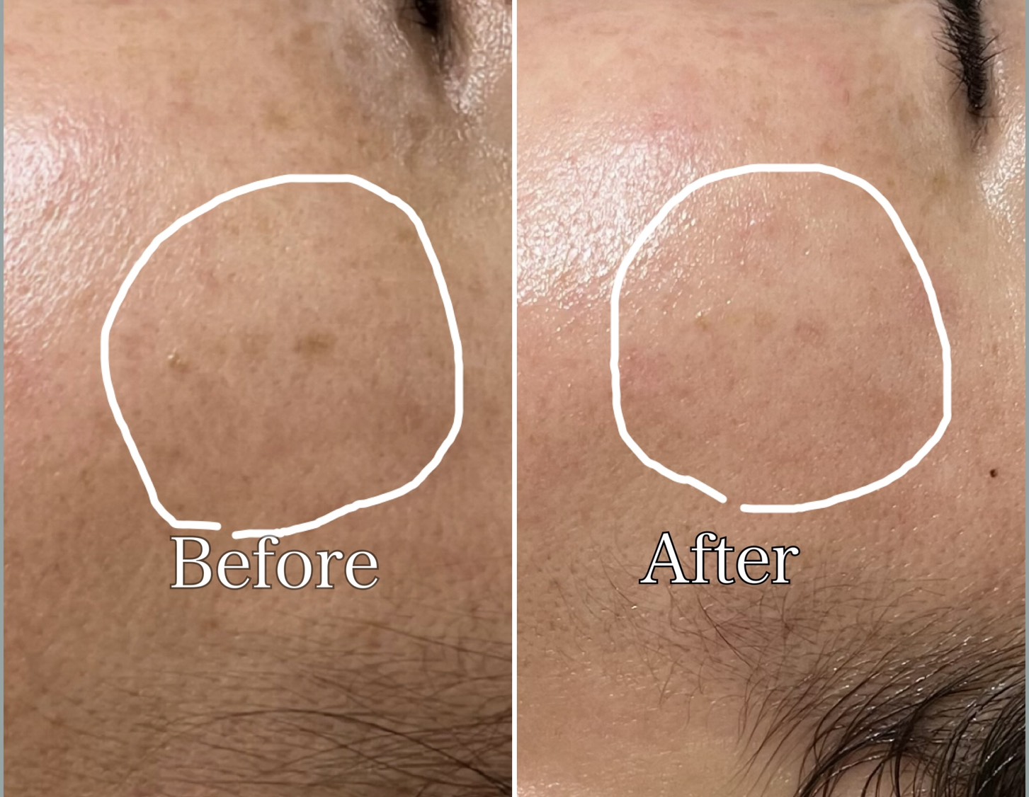 ダクトピール＋低周波シミケア Before/After