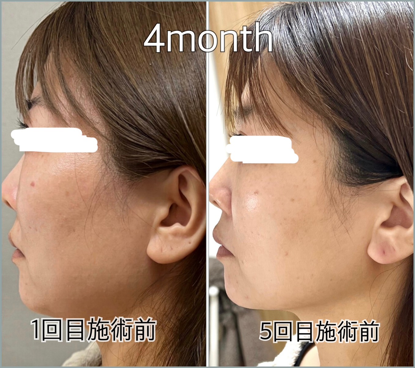 小顔・たるみ改善コース＋ダクトピール Before/After