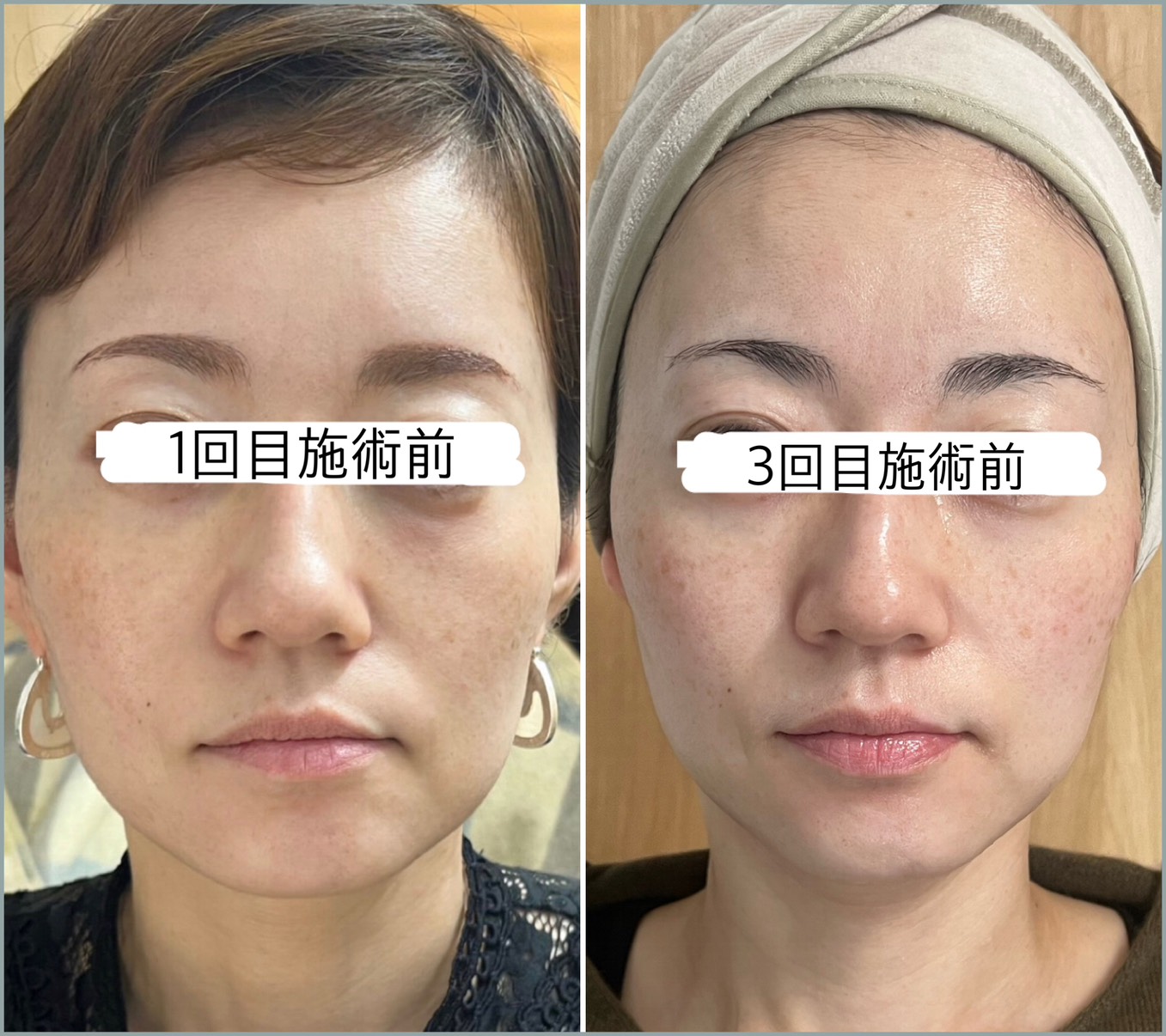 小顔・たるみ改善コース 前から Before/After