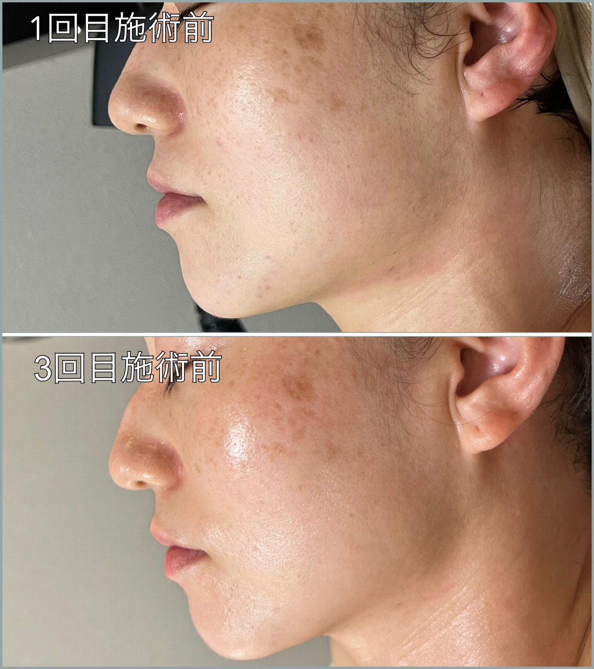 小顔・たるみ改善コース 横から Before/After