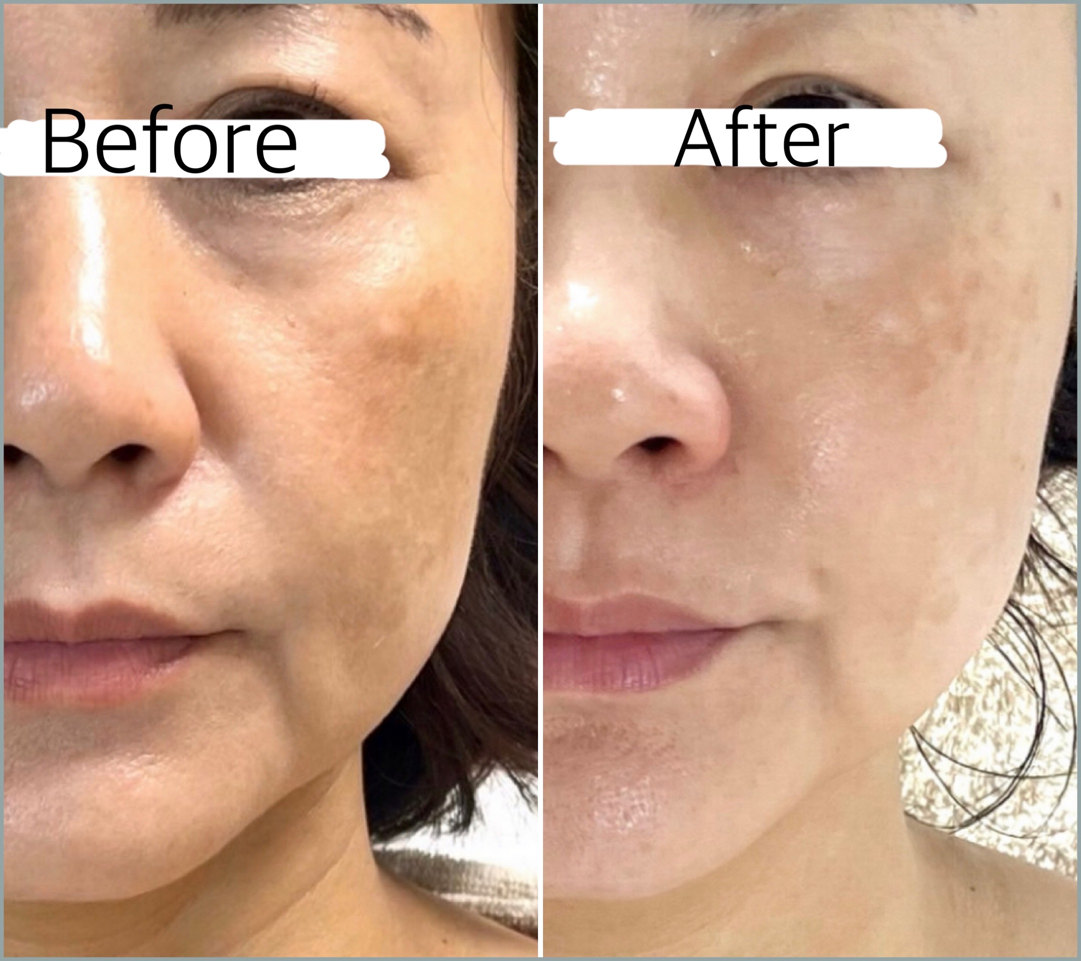 小顔・たるみ改善コース Before/After