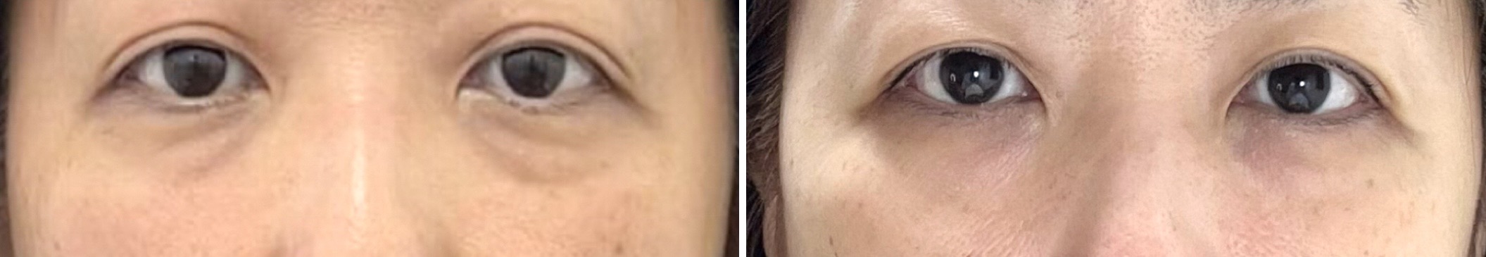 小顔・たるみ改善コース Before/After